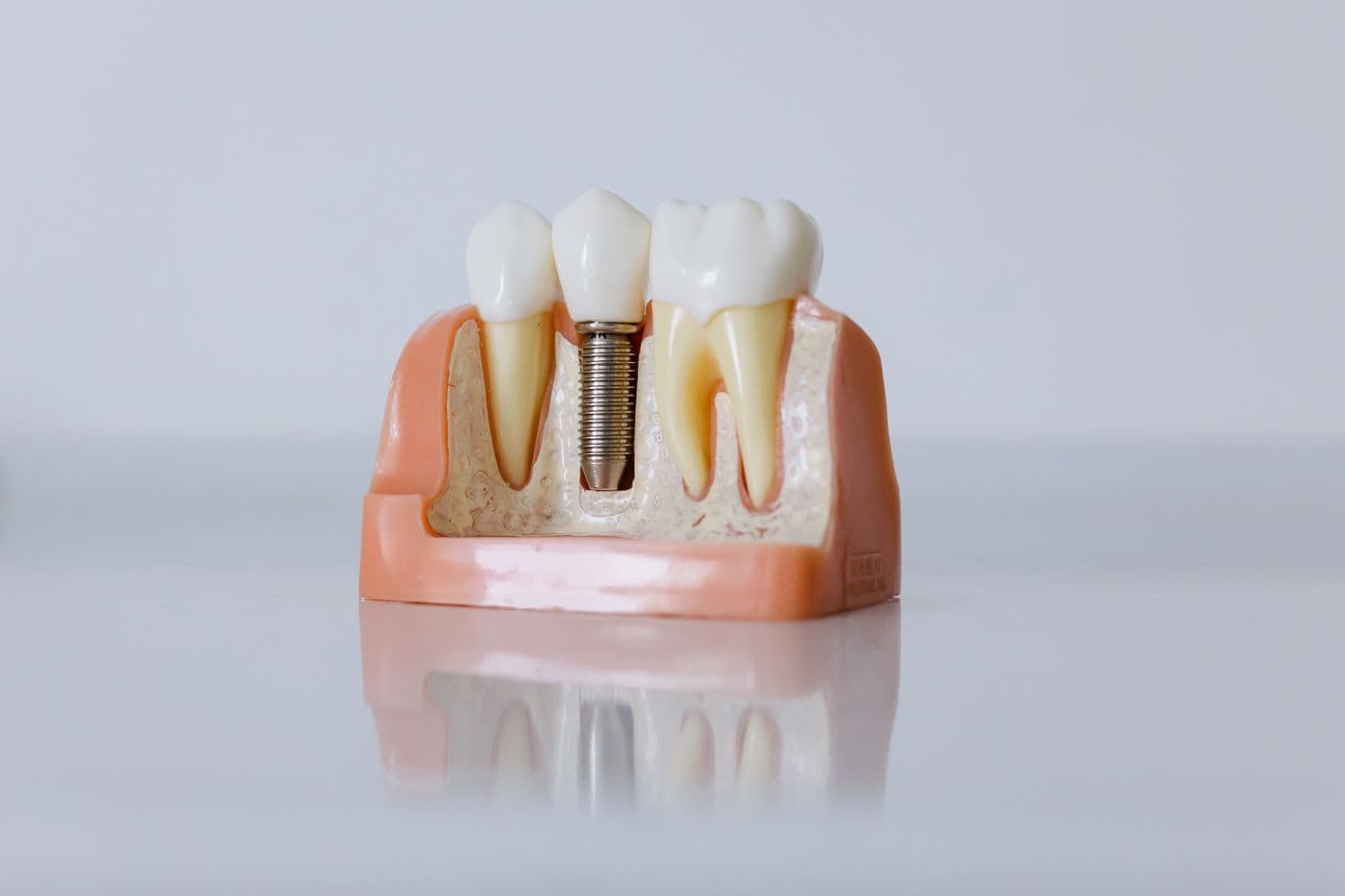 A dental implant model showing a titanium implant set between natural teeth